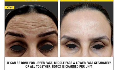 BEST BOTOX CLINIC IN CHANDIGARH